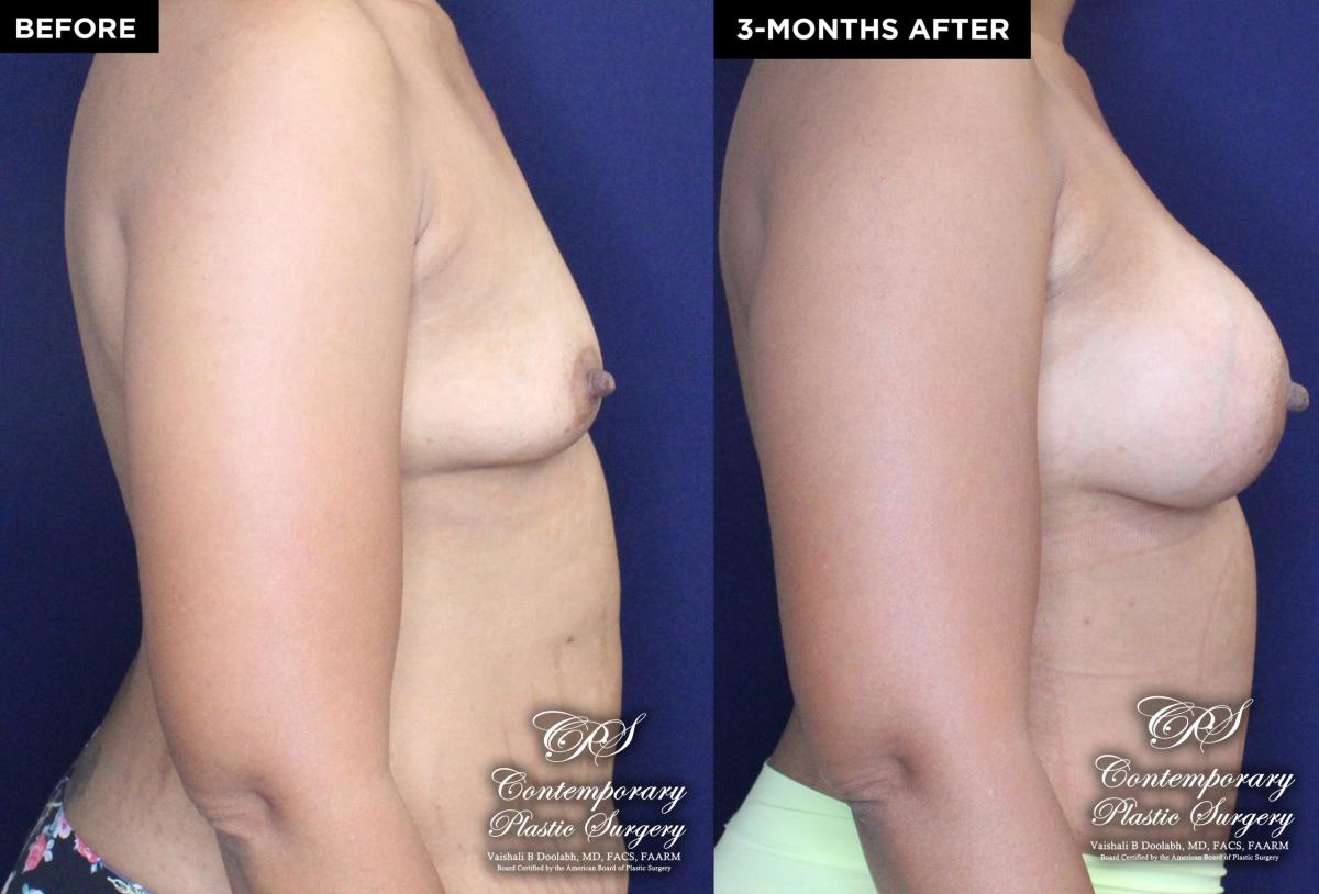 Patient 18489 breast augmentation before and after results at Contemporary Plastic Surgery