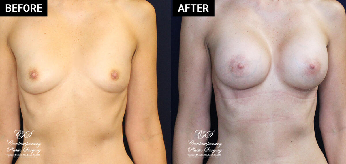 breast augmentation mammoplasty patient results at Contemporary Plastic Surgery