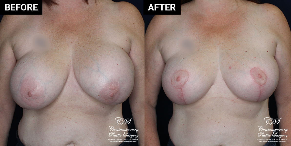 Breast implant replacement patient results at Contemporary Plastic Surgery
