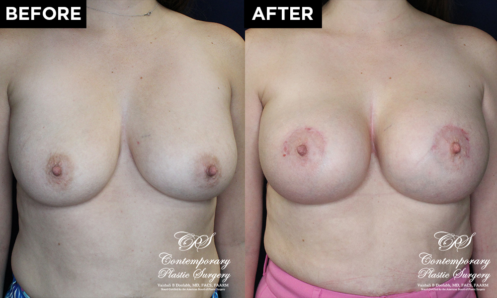 breast augmentation before and after results at Contemporary Plastic Surgery
