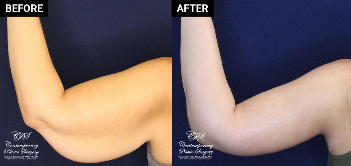 Arm lift patient results at Contemporary Plastic Surgery