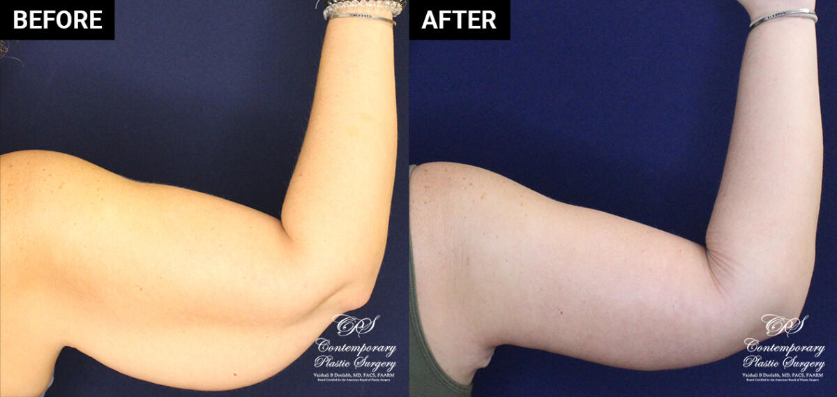 Arm lift patient results at Contemporary Plastic Surgery