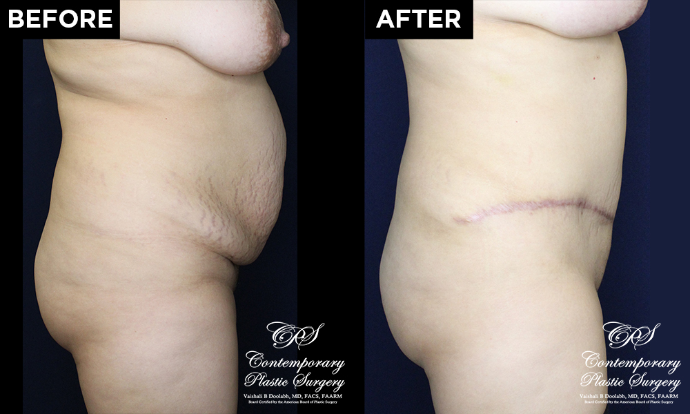 tummy tuck patient results at Contemporary Plastic Surgery