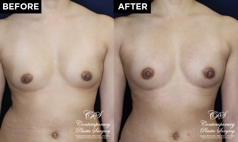 fat transfer breast augmentation patient #18742 results at Contemporary Plastic Surgery