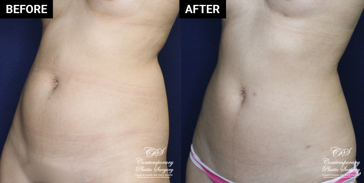 Liposuction patient results at Contemporary Plastic Surgery