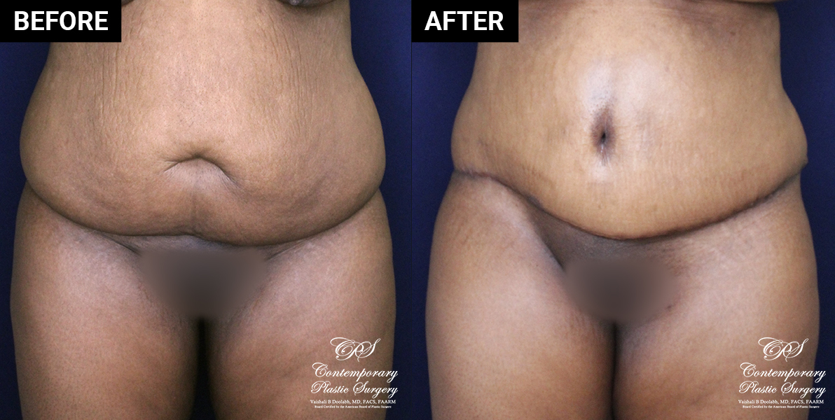 Tummy tuck patient results at Contemporary Plastic Surgery