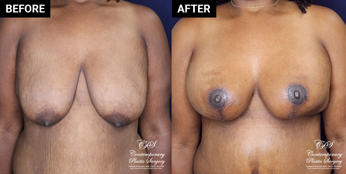 Breast augmentation patient results at Contemporary Plastic Surgery