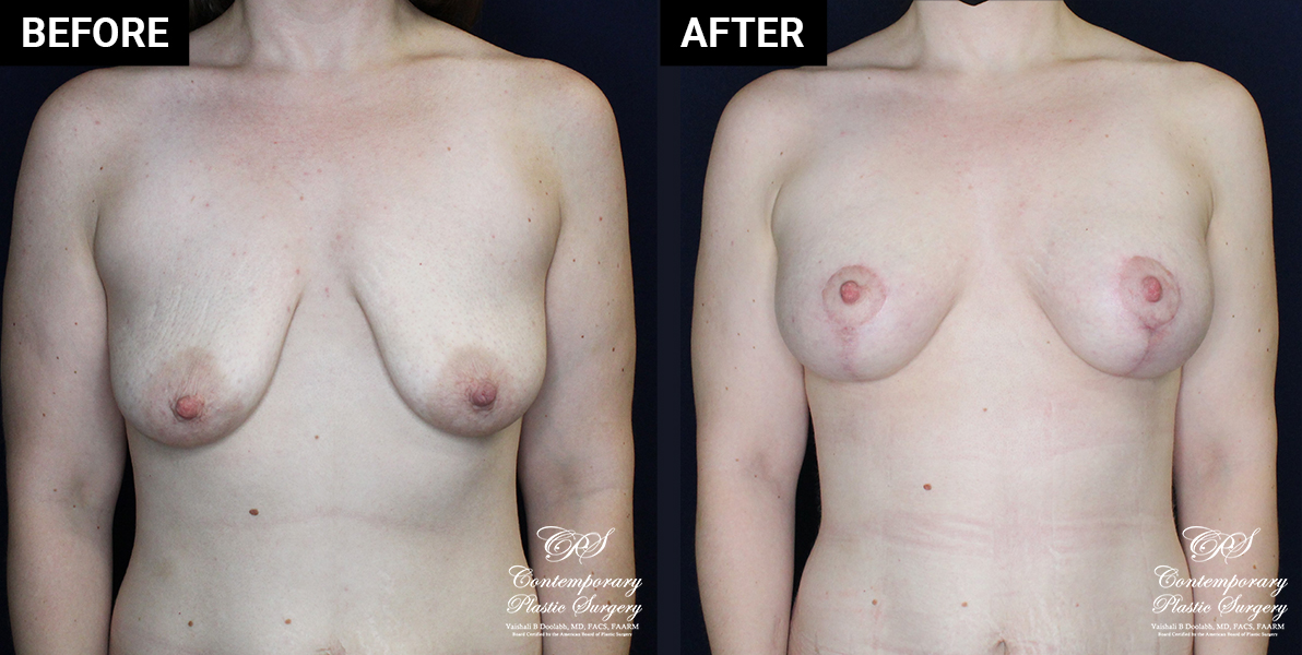 Mastopexy and breast implant results at Contemporary Plastic Surgery