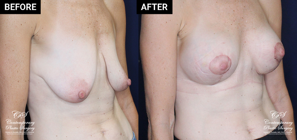 breast augmentation with mastopexy before and after results