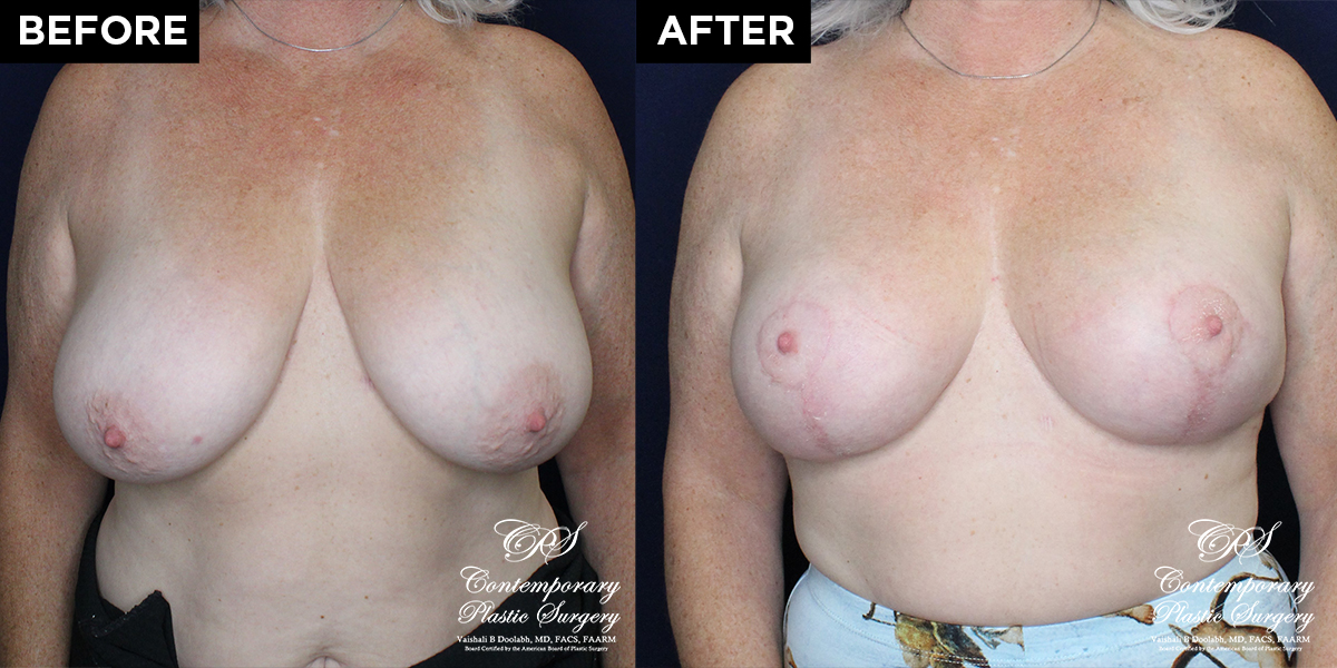 breast reduction and lift before and after results