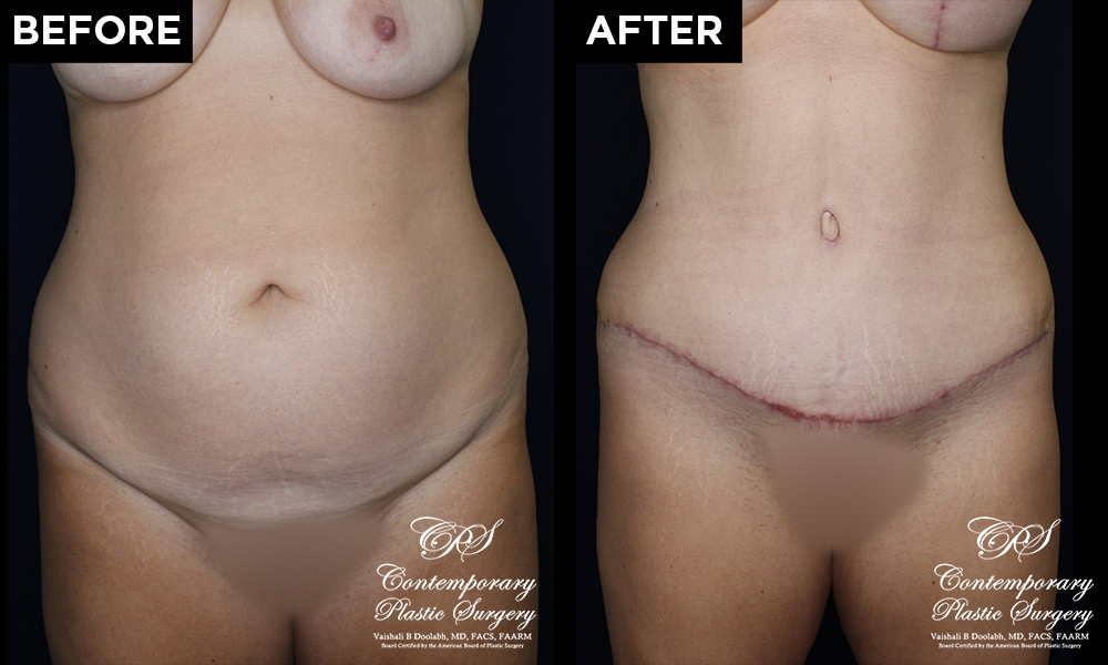 Tummy tuck before and after results at Contemporary Plastic Surgery