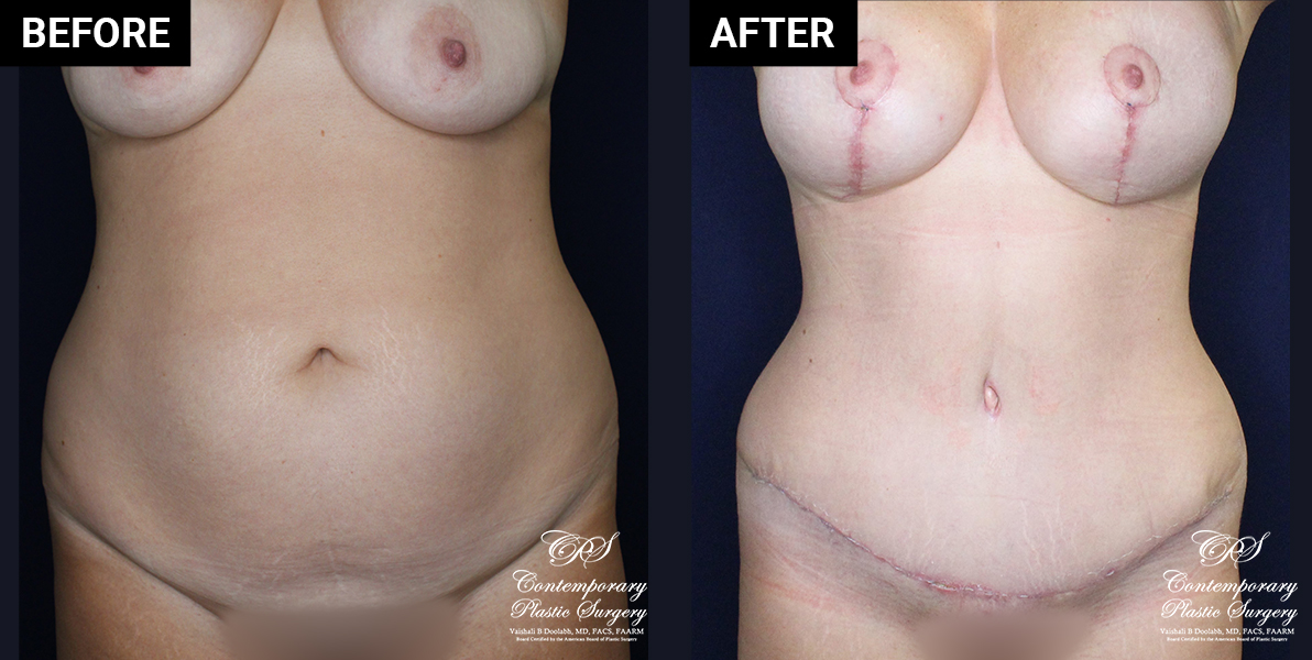 Abdominoplasty and breast augmentation patient results at Contemporary Plastic Surgery