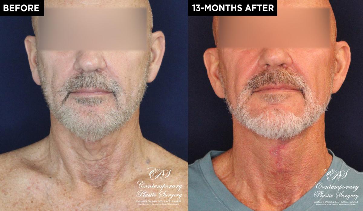 Patient 18982 neck lift before and after results at Contemporary Plastic Surgery