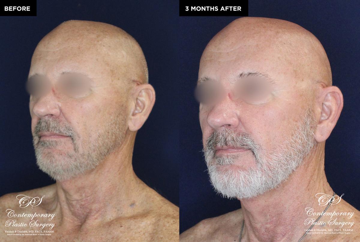 patient 18982 neck lift results at Contemporary Plastic Surgery