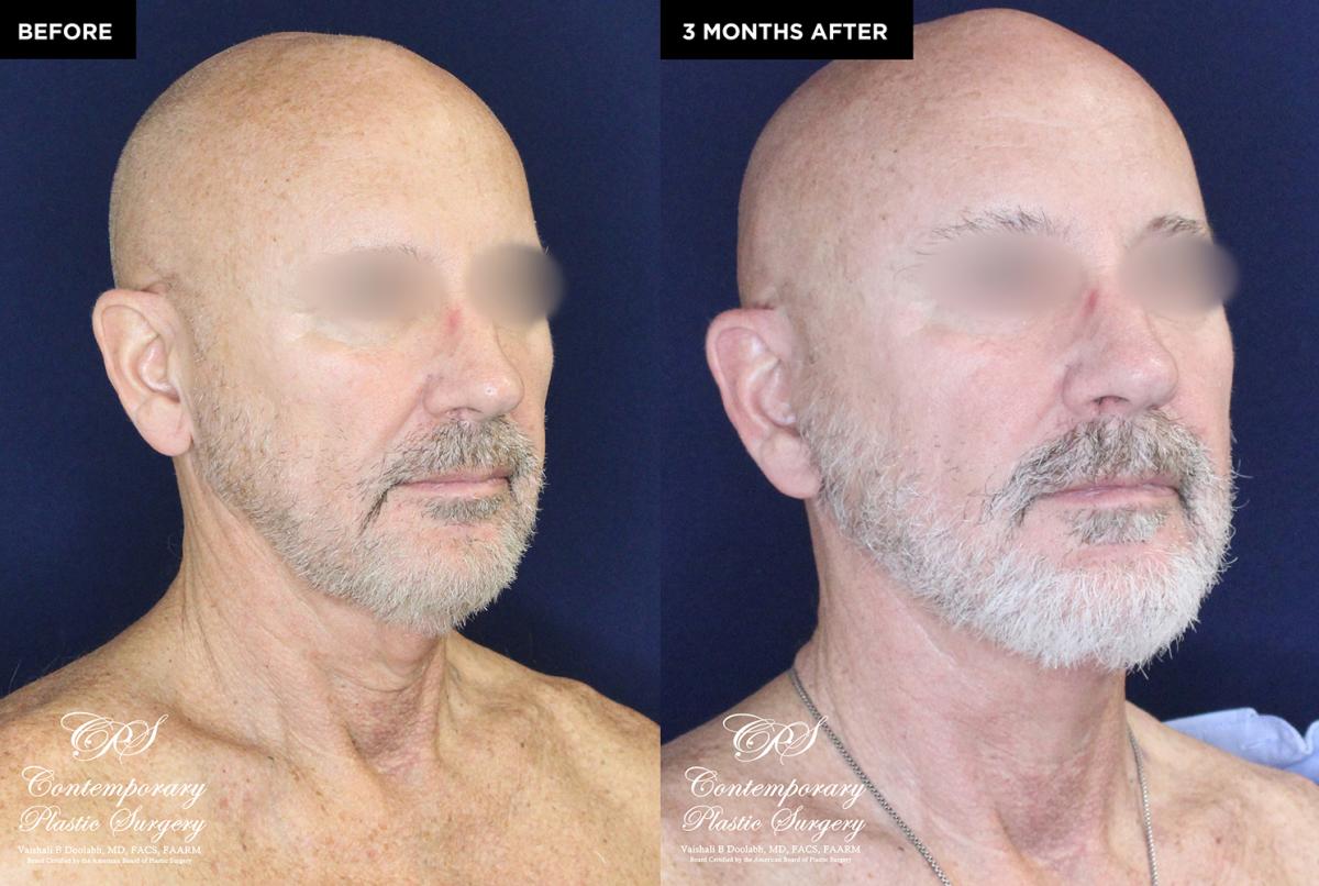 patient 18982 neck lift results at Contemporary Plastic Surgery