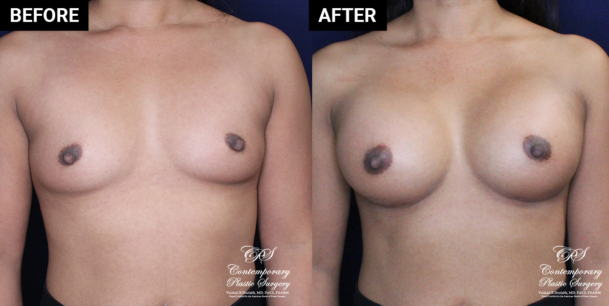 breast augmentation patient results at Contemporary Plastic Surgery