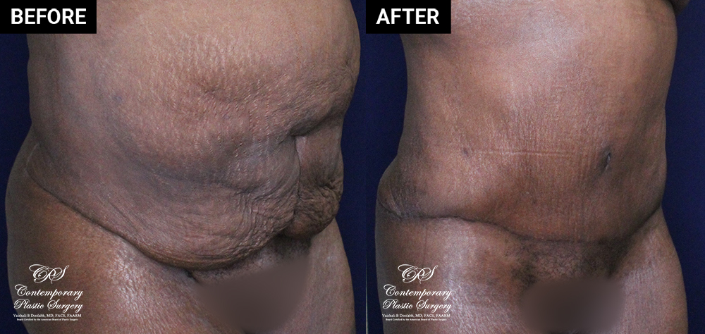 tummy tuck and liposuction patient results at Contemporary Plastic Surgery