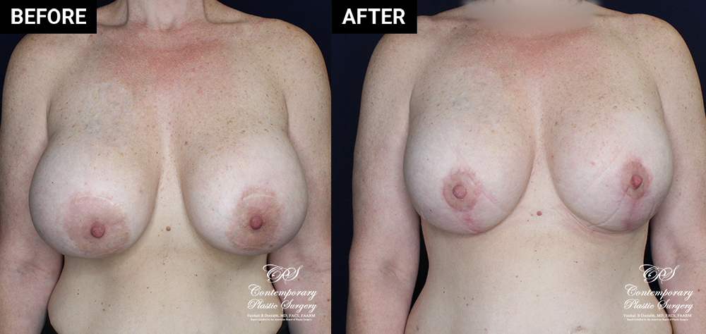 breast lift with implants patient results at Contemporary Plastic Surgery