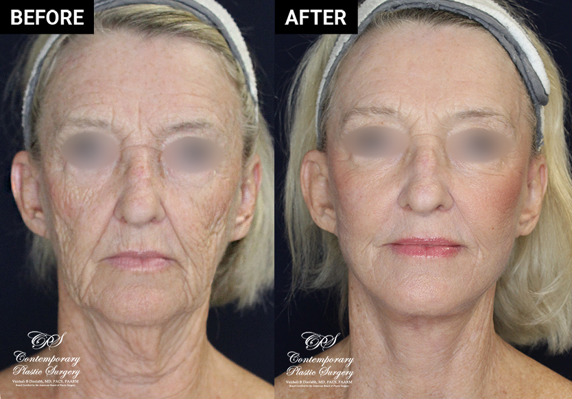 face and neck lift before and after results at Contemporary Plastic Surgery