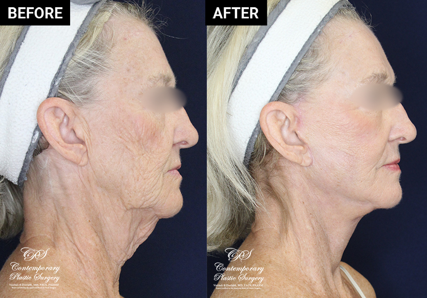 face and neck lift before and after results at Contemporary Plastic Surgery