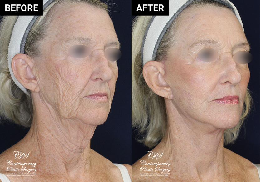 face and neck lift before and after results at Contemporary Plastic Surgery