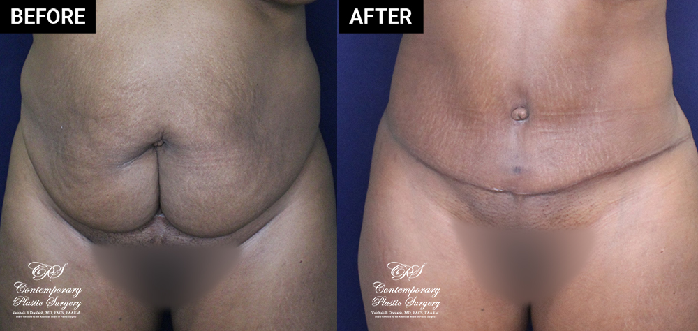 tummy tuck and liposuction patient before and after results at Contemporary Plastic Surgery