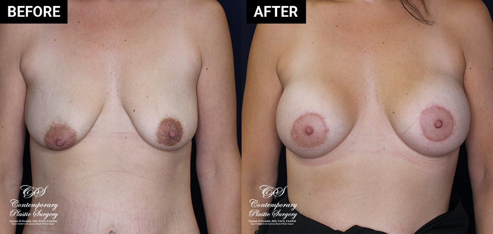 breast augmentation before and after results at Contemporary Plastic Surgery