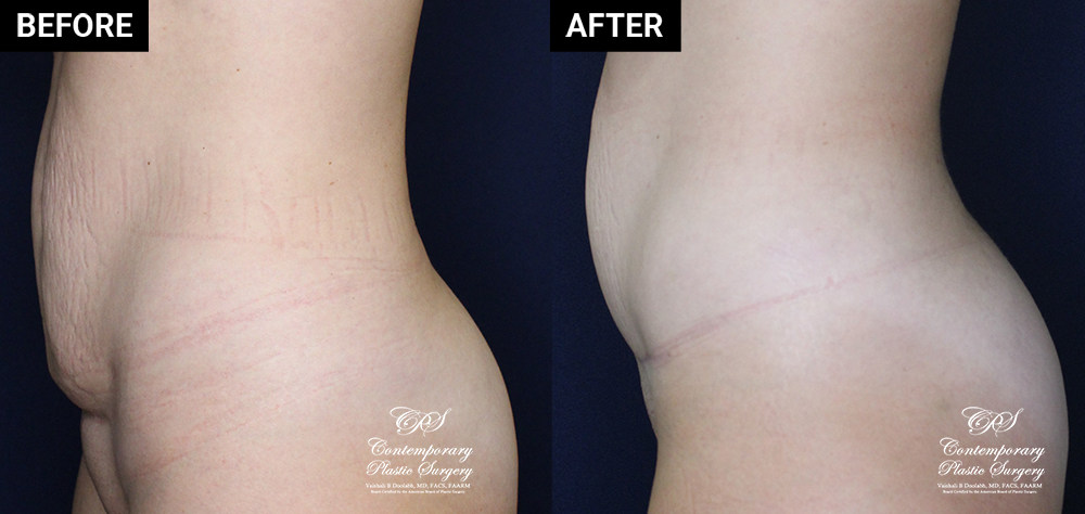 mini tummy tuck patient before and after results at Contemporary Plastic Surgery