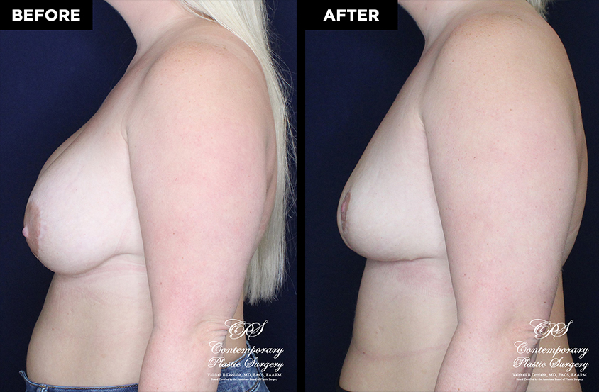 breast implant removal with replacement at Contemporary Plastic Surgery