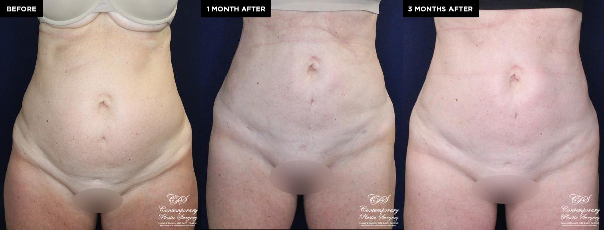 Enhanced contouring before and after results with liposuction and Renuvion®