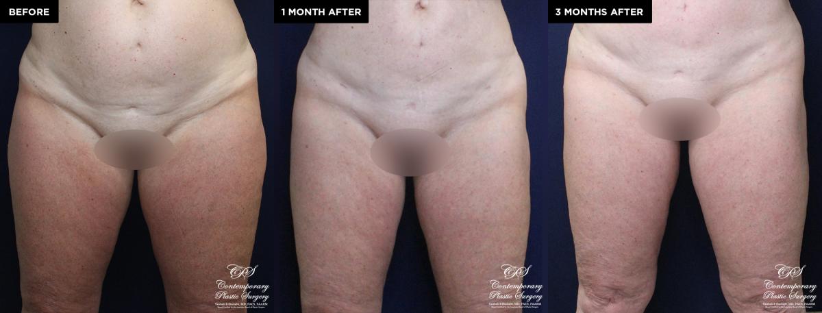 Enhanced contouring before and after results with liposuction and Renuvion®