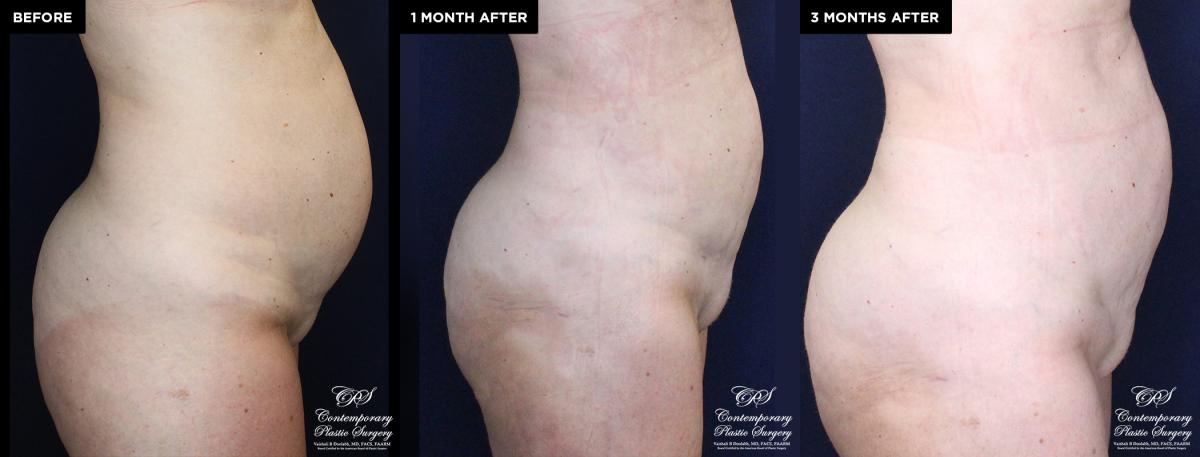 Enhanced contouring before and after results with liposuction and Renuvion®