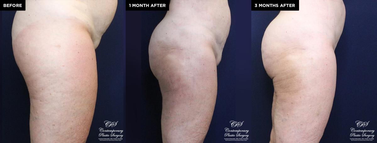 Enhanced contouring before and after results with liposuction and Renuvion®