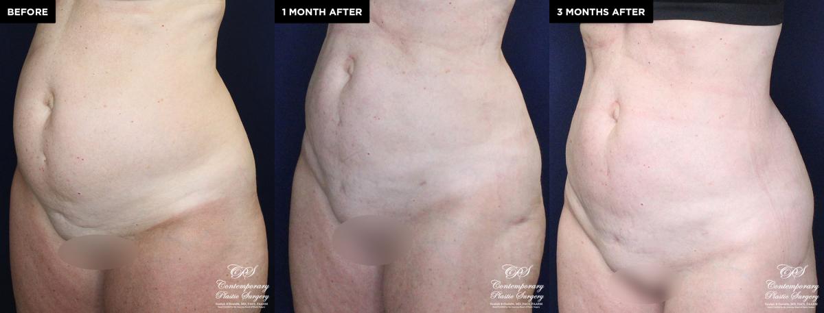 Enhanced contouring before and after results with liposuction and Renuvion®