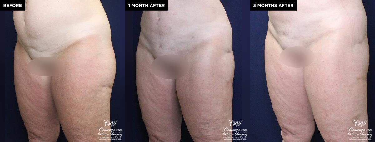 Enhanced contouring before and after results with liposuction and Renuvion®