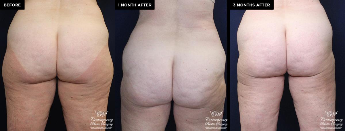 Enhanced contouring before and after results with liposuction and Renuvion®