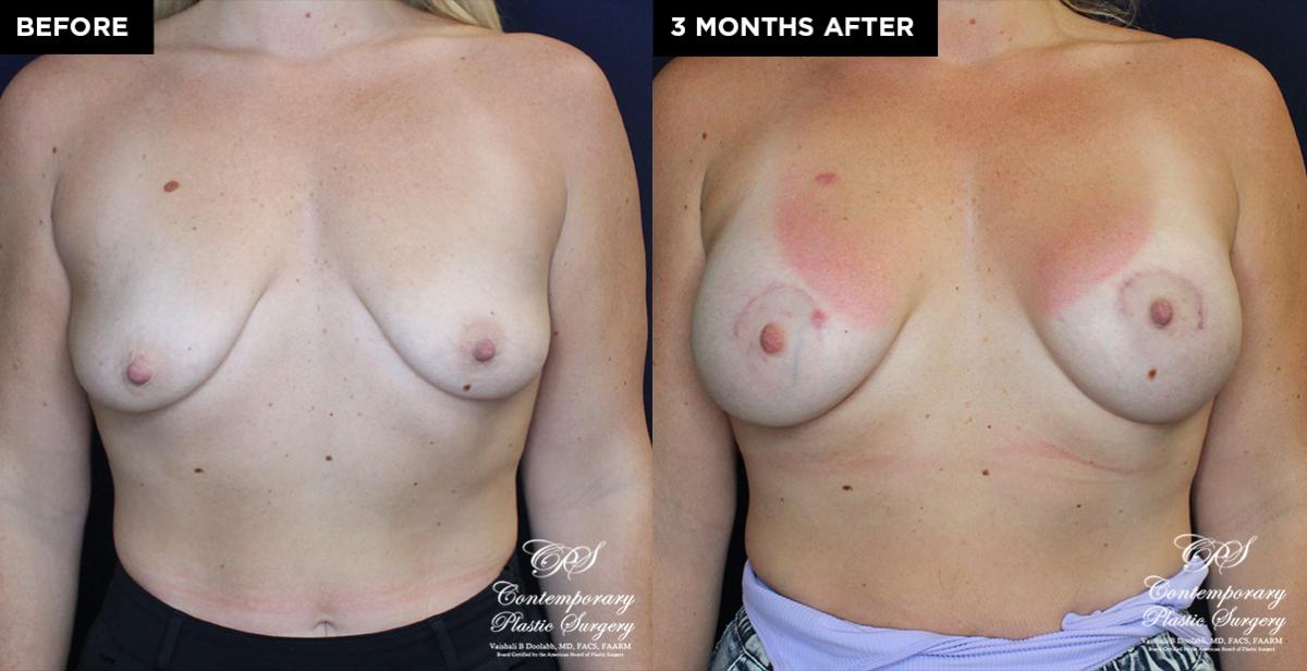 breast implants before and after results at Contemporary Plastic Surgery