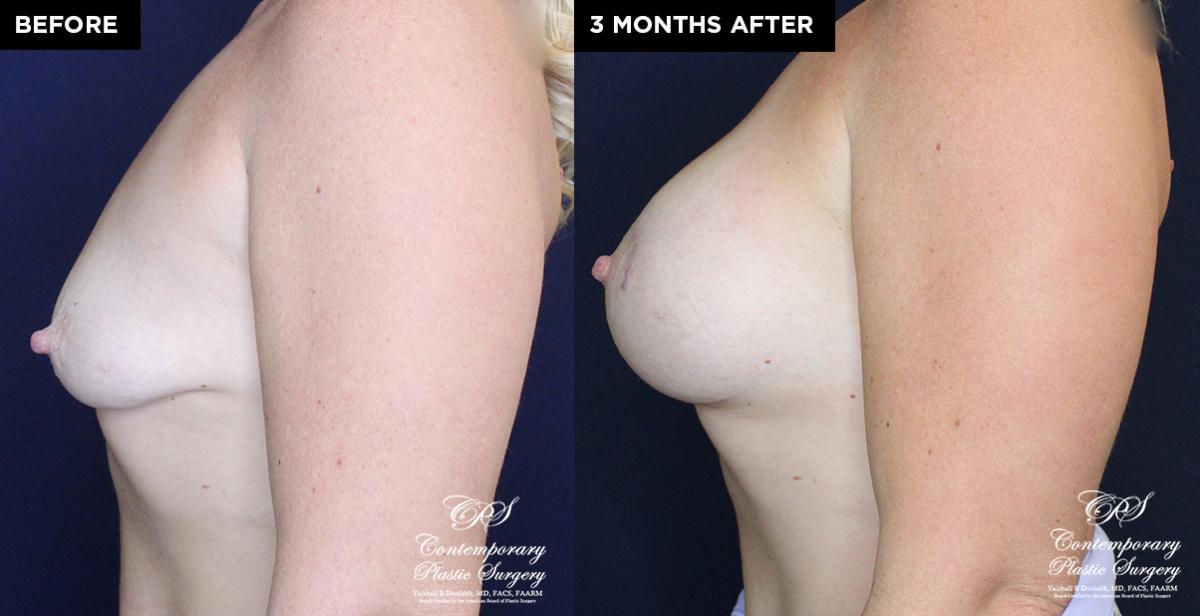 breast implants before and after results at Contemporary Plastic Surgery