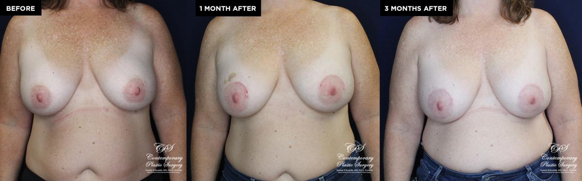 breast implant replacement at Contemporary Plastic Surgery