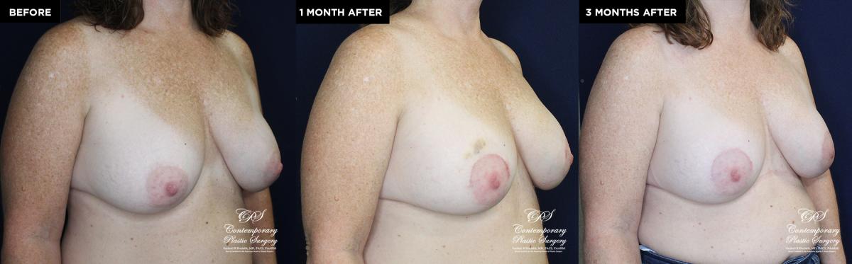 breast implant replacement at Contemporary Plastic Surgery