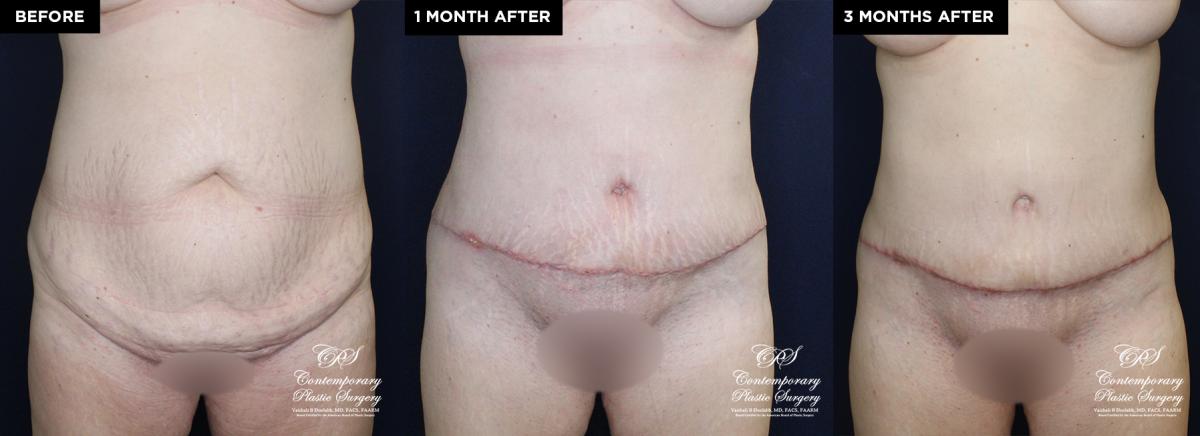 tummy tuck and liposuction patient results at Contemporary Plastic Surgery