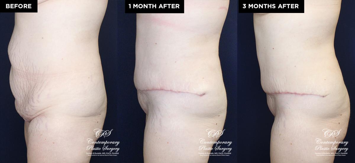 tummy tuck and liposuction patient results at Contemporary Plastic Surgery