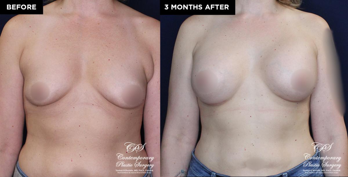breast implant patient 19597 before and after results at Contemporary Plastic Surgery