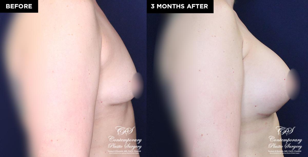 breast implant patient 19597 before and after results at Contemporary Plastic Surgery