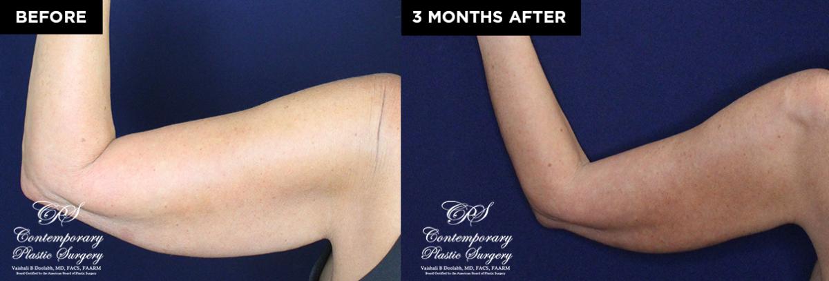 patient 19639 before and after subdermal Renuvion results at Contemporary Plastic Surgery