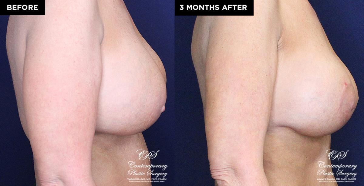 patient 19639 breast implant removal and replacement before and after results at Contemporary Plastic Surgery