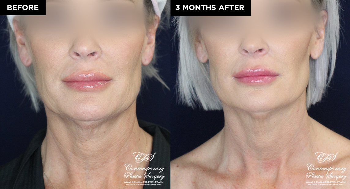 patient 19639 thread neck lift before and after results at Contemporary Plastic Surgery