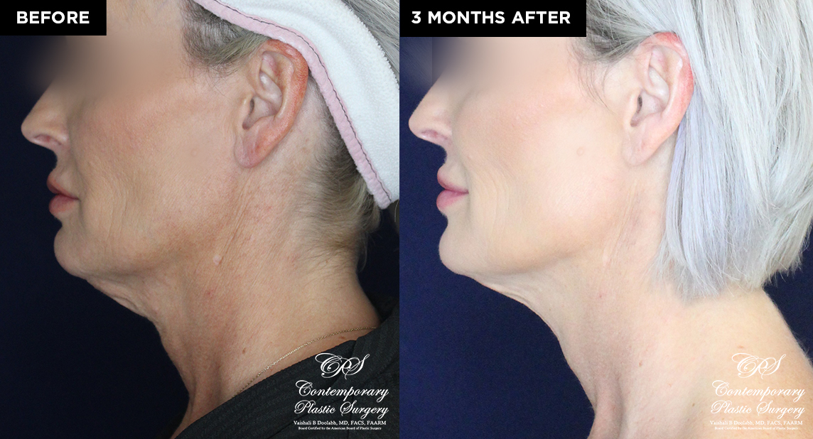 patient 19639 thread neck lift before and after results at Contemporary Plastic Surgery