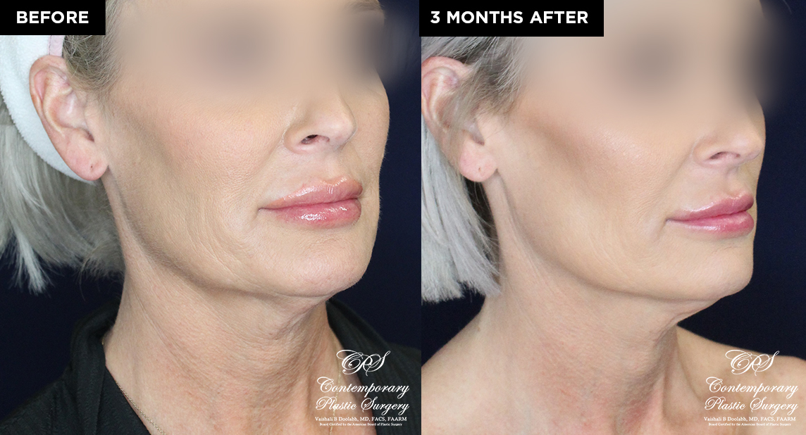 patient 19639 thread neck lift before and after results at Contemporary Plastic Surgery