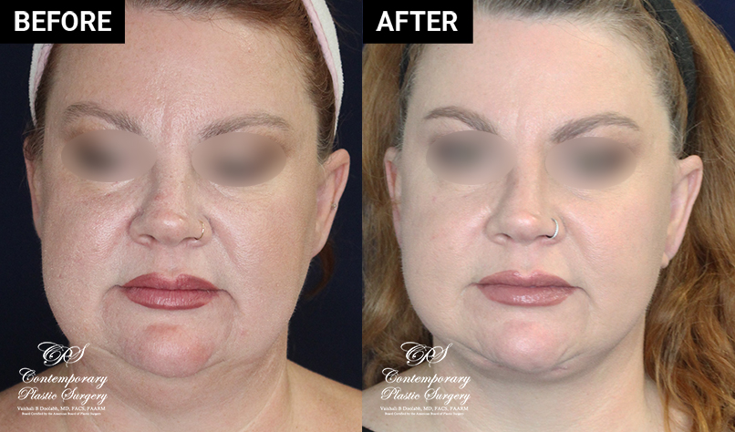 patient 19644 before and after results at Contemporary Plastic Surgery